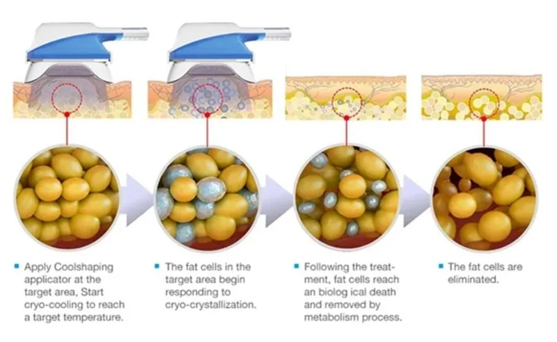 360 Cryo Lipo Laser Machine 9 360 Cryo Lipo Laser Machine 9