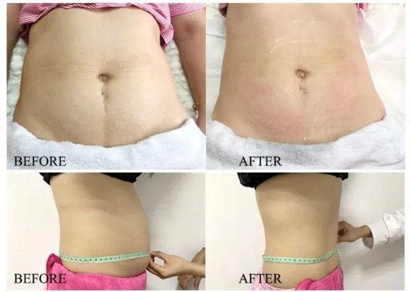 360 Cryoslim Machine 9 360 Cryoslim Machine 9